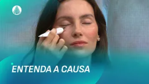 Olheiras: descubra o tratamento certo para o seu caso | Viva a Tarde