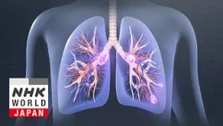 When Lung Cancer Strikes Nonsmokers - Medical Frontiers