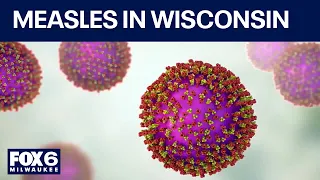 Measles in Wisconsin, cases rising as school season approaches | FOX6 News Milwaukee