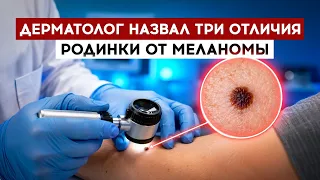A dermatologist named three differences between a mole and melanoma.
