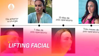 Lifting facial moderno: quando vale a pena fazer o procedimento? | Viva a Tarde