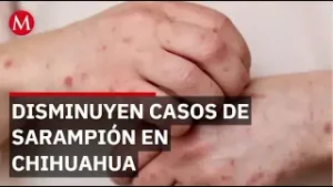 Vacunación reduce casos de sarampión en Chihuahua