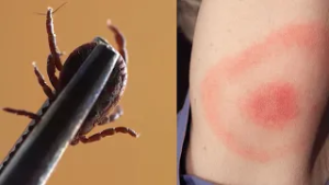 Ganzjahres-Problem? OÖ ist „Zecken-Bundesland“