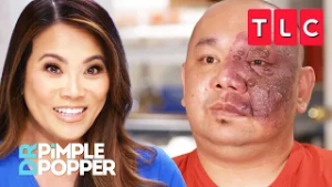 Port-Wine Stains and Other Birthmarks | Dr. Pimple Popper | TLC