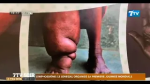 Lymphoedème: Le Sénégal organise sa première journée mondiale