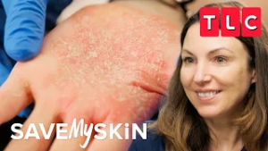 Abscess, Boils, and Ooze | Save My Skin | TLC