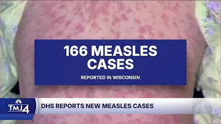 Measles cases confirmed in Wisconsin