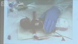 Successful Heart Surgery on Infant: World's Smallest at 356g (October 20, 2026)