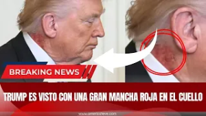 ?ALARMA: Trump es visto con una gran mancha roja en el cuello -  America Noticias USA