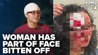Seattle woman recounts having part of face bitten off by suspect in downtown