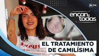 How does LASER work for SCARS? | Encantadas