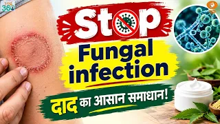 Yog 360 | Ringworm से राहत के लिए Yoga और Nutrition! Immunity & Skin Health के आसान Tips