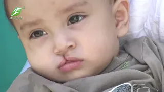 د افغاني سرې میاشتې او د بنګدېش اسلامي مرکز په همکارۍ، د شونډو او تالو چاودو لرونکو ناروغانو د جراحي