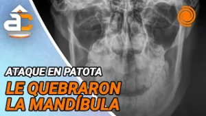 Atacaron a patadas a un joven y le fracturaron la mandíbula a la salida de un boliche
