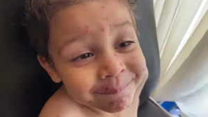 SARAMPIÓN EN QUERÉTARO: ACTUALIZACIÓN