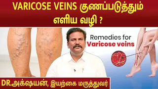 VARICOSE VEINS குணப்படுத்தும் எளிய வழி ? | Cure varicose veins | Dr.Akshayan