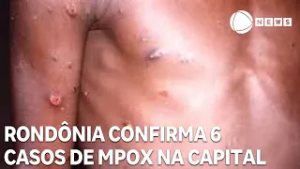 Rondônia confirma 6 casos de Mpox na capital Porto Velho e pacientes seguem isolados
