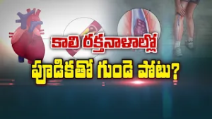 కాలి రక్తనాళాల్లో పూడికలతో గుండె పోటు? | Heartattack risk with Peripheral artery disease| Sukhibhava