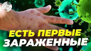 Оспа обезьян проникла в Россию. Начались заражения. Будет новая эпидемия?